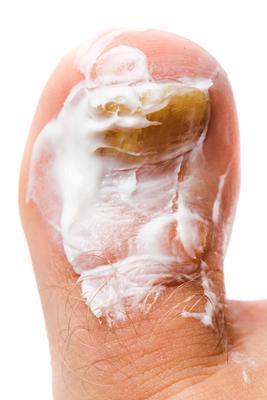 白斑多肉是因为什么引起的 白斑多肉有哪些临床表现