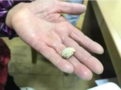 痛风病人的饮食护理 通风该怎么治疗