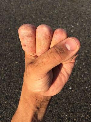 腱鞘炎吃什么补 腱鞘炎的发病原因有哪些